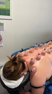 cupping
